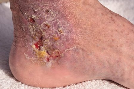 Cellulitis-Signs-and-Symptoms-722x406