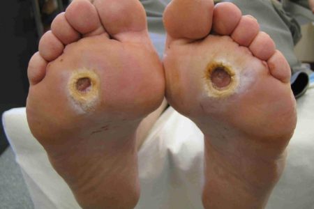 bilateral-neuropathic-foot-ulcers-1024x768